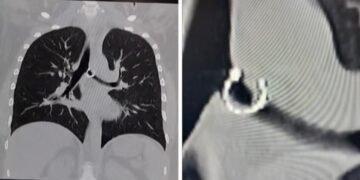 Empezó a toser y un mes después descubrió un objeto insólito en sus pulmones