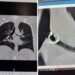 Empezó a toser y un mes después descubrió un objeto insólito en sus pulmones